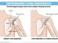 Porównanie zdrowego stawu ramiennego z tym dotkniętym chorobą zwyrodnieniową stawów, gdzie chrząstka jest zniszczona.