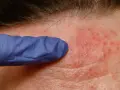 Dłoń w niebieskiej rękawiczce bada zaczerwienioną skórę czoła z licznymi krostkami i grudkami.