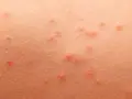 Alergia pokarmowa objawy na skórze – rozpoznaj niebezpieczne symptomy