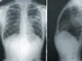 RTG klatki piersiowej pokazuje zmiany sugerujące zapalenie płuc. Widoczne są zacienienia w płucach, które mogą wskazywać na infekcję.