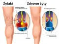 Ilustracja porównująca nogę z żylakami i zdrową nogę, z powiększeniami naczyń krwionośnych.