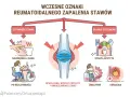 Wczesne oznaki reumatoidalnego zapalenia stawów: sztywność, opuchlizna, utrata apetytu, zmęczenie, gorączka.