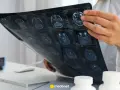 Lekarz analizuje obraz rezonansu magnetycznego mózgu, szukając oznak glejaka.