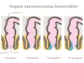 Ilustracja przedstawia cztery etapy rozwoju hemoroidów wewnętrznych, od I do IV stopnia, pokazując ich powiększanie się w obrębie odbytu.