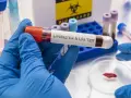 Badanie lipoproteiny A (LPA) to analiza krwi oceniająca ryzyko chorób serca.