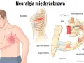Ilustracja przedstawia mężczyznę z bólem w klatce piersiowej oraz schemat nerwów międzyżebrowych i kręgosłupa.