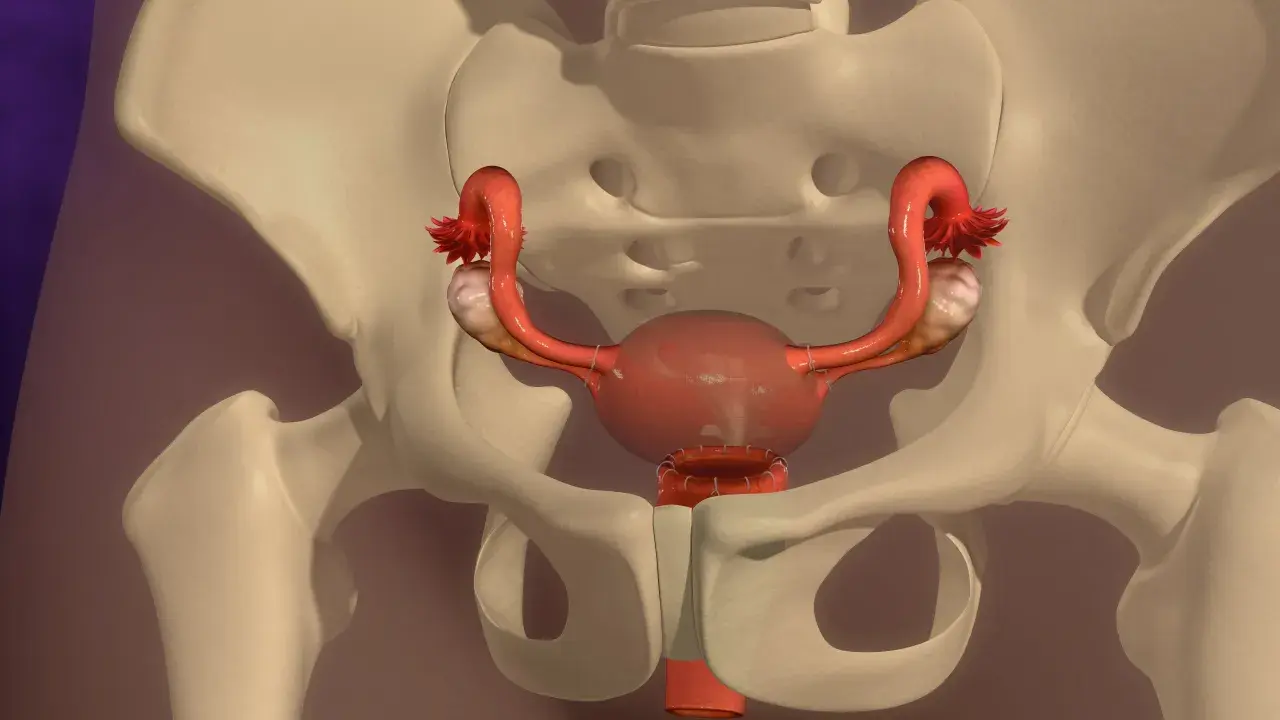 Anatomical illustration of the female reproductive system within the pelvis, showing uterus, ovaries, and fallopian tubes.
