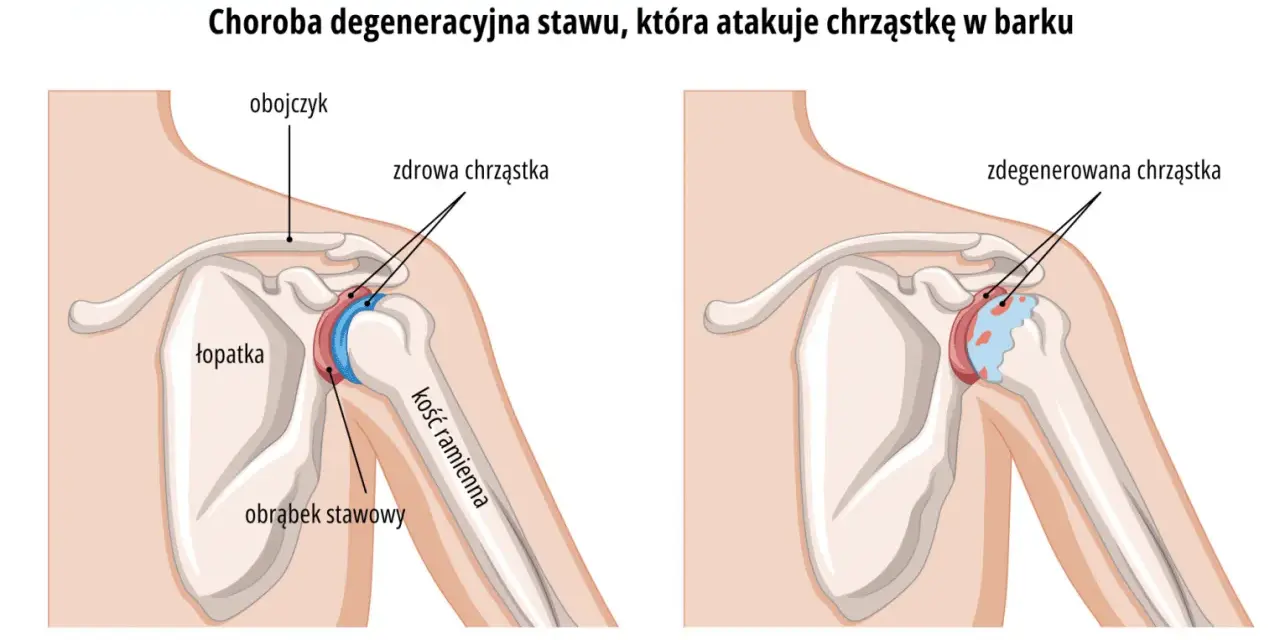 Porównanie zdrowego stawu ramiennego z tym dotkniętym chorobą zwyrodnieniową stawów, gdzie chrząstka jest zniszczona.