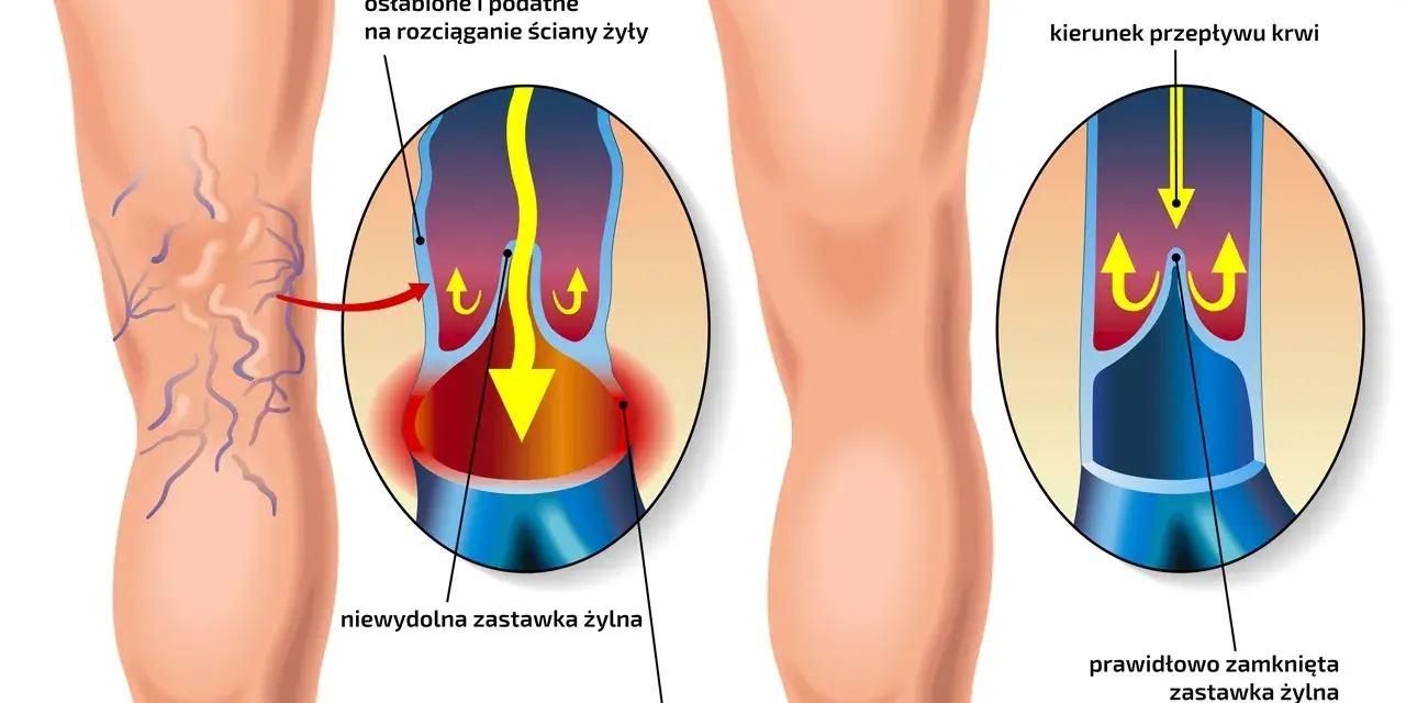Ilustracja porównująca nogę z żylakami i zdrową nogę, z powiększeniami naczyń krwionośnych.