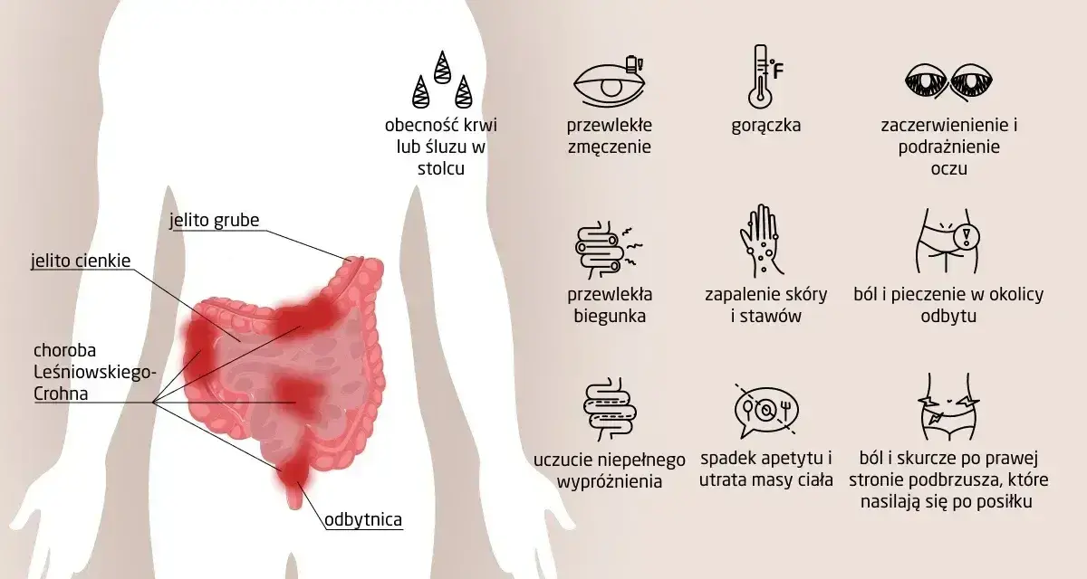 Ilustracja przedstawia objawy choroby Leśniowskiego-Crohna: krew w stolcu, zmęczenie, gorączkę, podrażnienie oczu, biegunkę, bóle stawów, pieczenie odbytu, spadek apetytu i bóle brzucha.