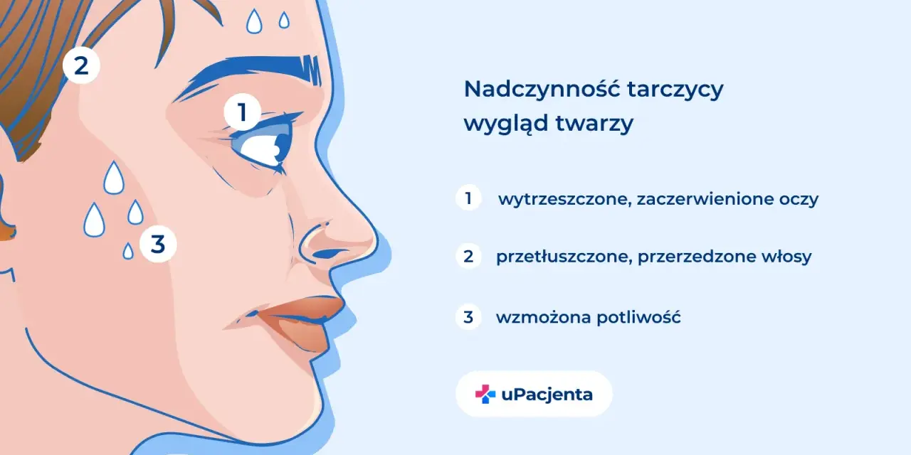 Nadczynność tarczycy objawy: wytrzeszczone oczy (1), przetłuszczone włosy (2) i wzmożona potliwość (3) na twarzy.