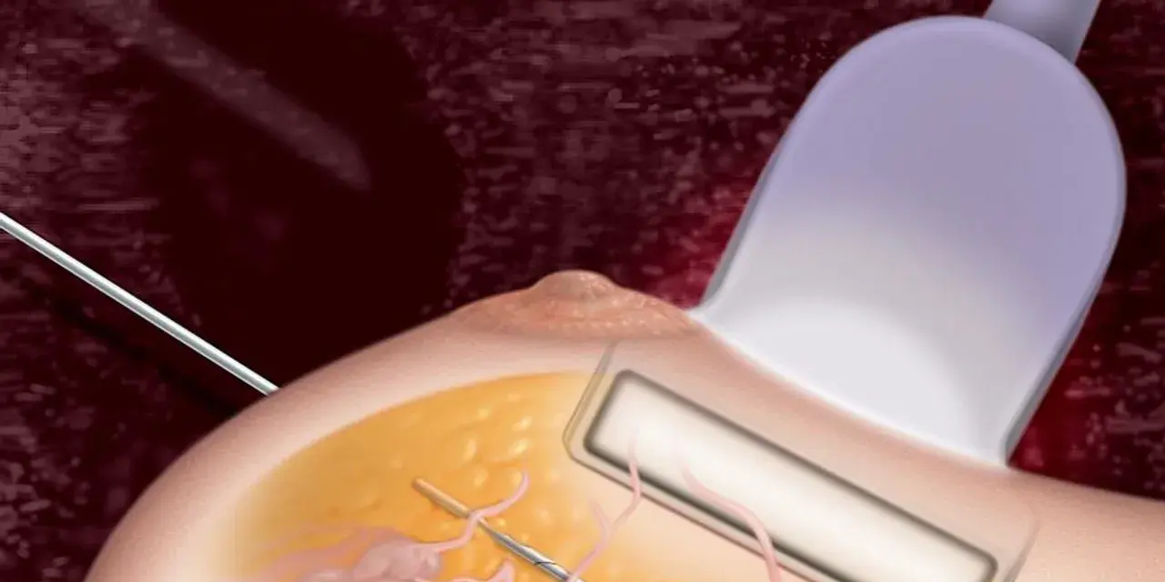 Ilustracja przedstawia biopsję mammotomiczną: igła biopsyjna pod kontrolą USG pobiera fragment tkanki piersi.