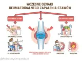 Wczesne oznaki reumatoidalnego zapalenia stawów: sztywność, opuchlizna, utrata apetytu, zmęczenie, gorączka.