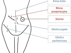 Przepuklina pachwinowa do jakiego lekarza? Kluczowe informacje dla pacjentów