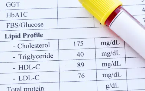 Wynik lipidogramu: cholesterol 175, trójglicerydy 40, HDL-C 89, LDL-C 76 mg/dL. To badanie ocenia poziom tłuszczów we krwi.