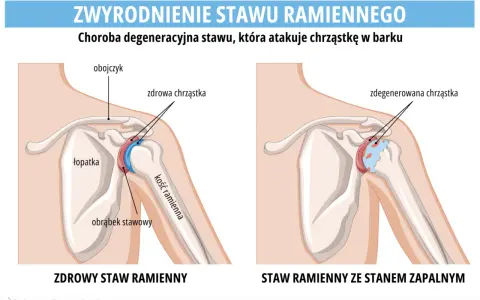 Porównanie zdrowego stawu ramiennego z tym dotkniętym chorobą zwyrodnieniową stawów, gdzie chrząstka jest zniszczona.