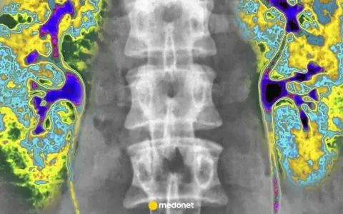 Kolorowa scyntygrafia kości pokazuje nerki i kręgosłup. Obraz uwidacznia obszary o różnej aktywności metabolicznej.