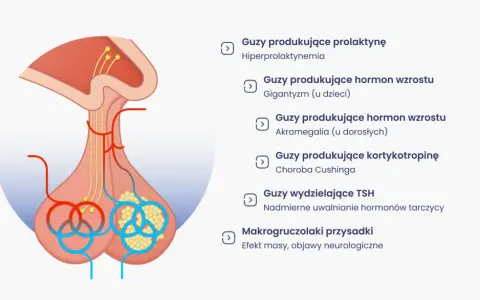 Ilustracja przysadki mózgowej z listą różnych guzów i ich objawów, np. guz przysadki mózgowej objawy.