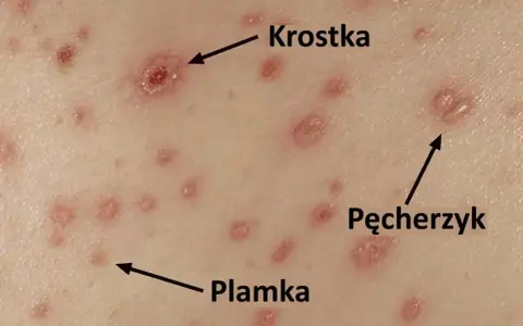 Początki ospy: czerwone plamki, krostki i pęcherzyki na skórze.
