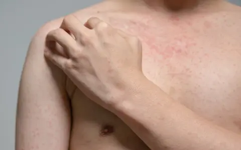 Czerwona, swędząca mononukleoza wysypka pokrywa klatkę piersiową i ramię, które osoba drapie.