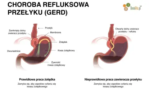Ilustracja pokazuje prawidłowe i nieprawidłowe działanie żołądka, wyjaśniając objawy refluksu.