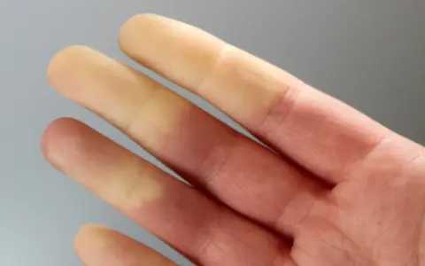 Palce dłoni z widocznym objawem Raynauda – białe, blade końcówki palców przechodzące w zaczerwienienie.