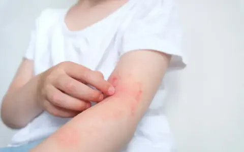 Dziecko drapie zaczerwienioną skórę na ramieniu, widoczne objawy alergii.