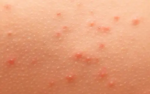 Alergia pokarmowa objawy na skórze – rozpoznaj niebezpieczne symptomy
