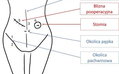 Przepuklina pachwinowa do jakiego lekarza? Kluczowe informacje dla pacjentów
