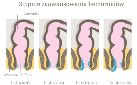 Ilustracja przedstawia cztery etapy rozwoju hemoroidów wewnętrznych, od I do IV stopnia, pokazując ich powiększanie się w obrębie odbytu.