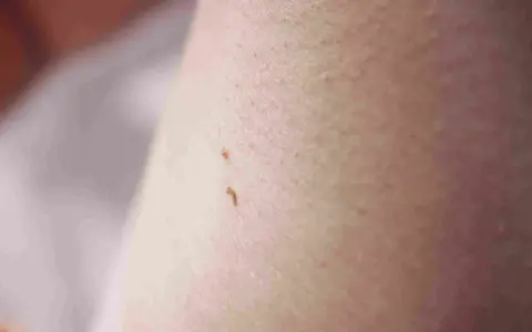 Dwa małe, brązowe znamiona na skórze, przypominające małe włókna.