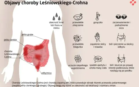 Ilustracja przedstawia objawy choroby Leśniowskiego-Crohna: krew w stolcu, zmęczenie, gorączkę, podrażnienie oczu, biegunkę, bóle stawów, pieczenie odbytu, spadek apetytu i bóle brzucha.