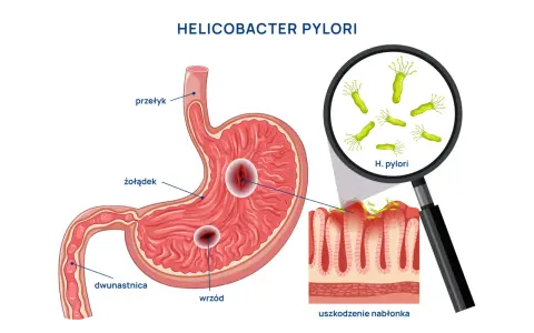 Helicobacter pylori powoduje wrzody żołądka i dwunastnicy, uszkadzając nabłonek.