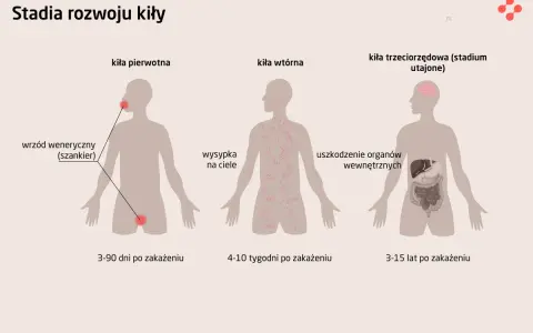 Ilustracja przedstawia stadia rozwoju kiły: pierwotne (wrzód), wtórne (wysypka) i trzeciorzędowe (uszkodzenie narządów).