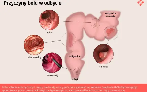 Ilustracja pokazuje przyczyny bólu w odbycie: polip, stan zapalny, hemoroidy, raka jelita, okrężnicę esowatą.