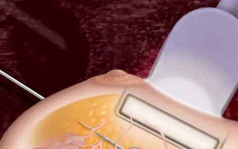 Ilustracja przedstawia biopsję mammotomiczną: igła biopsyjna pod kontrolą USG pobiera fragment tkanki piersi.