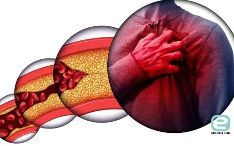 Postępująca choroba wieńcowa: zwężone naczynia krwionośne z cholesterolem i czerwonymi krwinkami, obok mężczyzna trzymający się za serce.