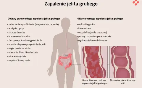 Zapalenie jelita grubego: objawy przewlekłe (biegunka, zaparcia, wzdęcia, bóle brzucha) i ostre (obfita biegunka, krew w kale, gorączka).