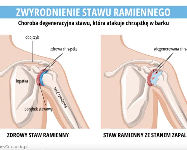 Porównanie zdrowego stawu ramiennego z tym dotkniętym chorobą zwyrodnieniową stawów, gdzie chrząstka jest zniszczona.