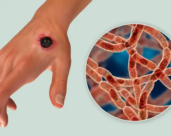 Dłoń z czarną martwiczą zmianą skórną, objawem wąglika. Obok powiększenie bakterii Bacillus anthracis.