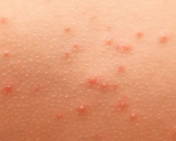 Alergia pokarmowa objawy na skórze – rozpoznaj niebezpieczne symptomy