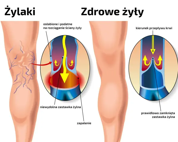 Ilustracja porównująca nogę z żylakami i zdrową nogę, z powiększeniami naczyń krwionośnych.