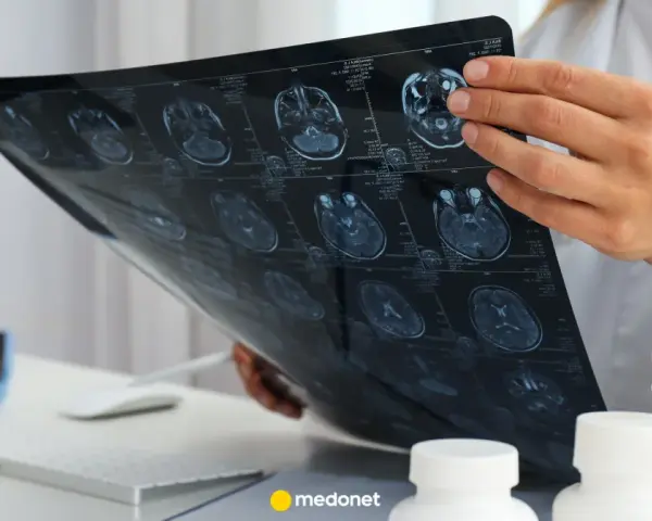 Lekarz analizuje obraz rezonansu magnetycznego mózgu, szukając oznak glejaka.