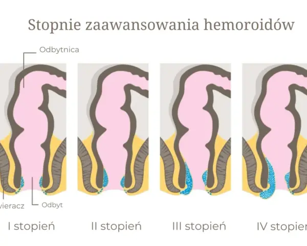 Ilustracja przedstawia cztery etapy rozwoju hemoroidów wewnętrznych, od I do IV stopnia, pokazując ich powiększanie się w obrębie odbytu.