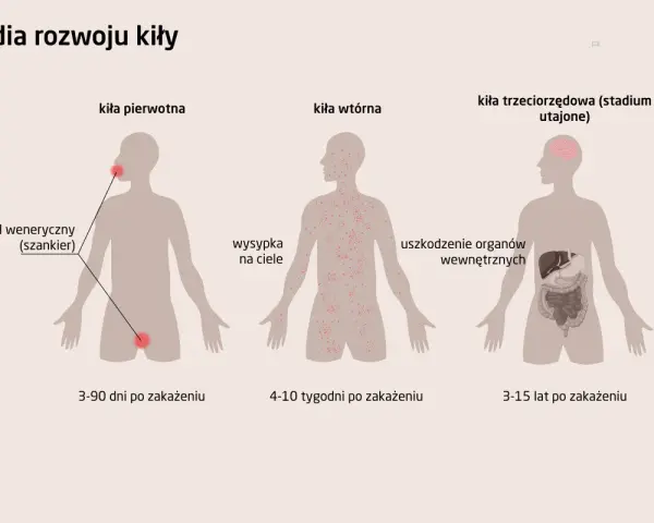 Ilustracja przedstawia stadia rozwoju kiły: pierwotne (wrzód), wtórne (wysypka) i trzeciorzędowe (uszkodzenie narządów).