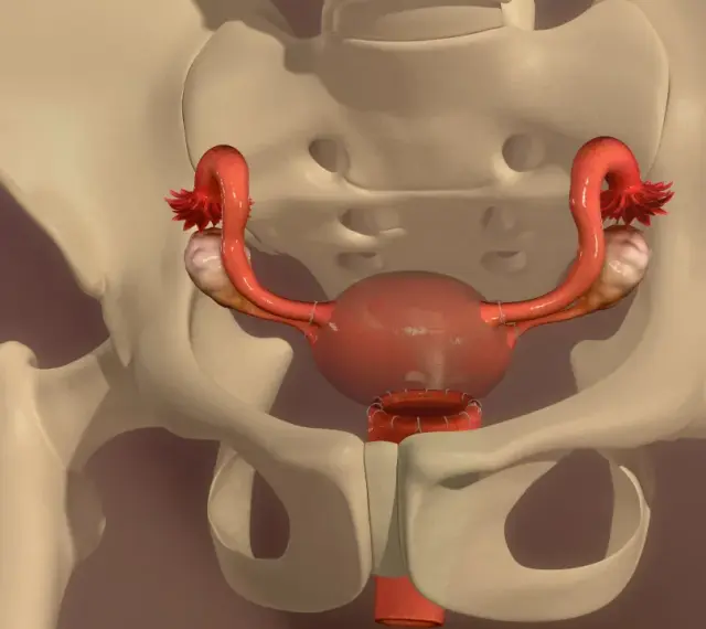 Anatomical illustration of the female reproductive system within the pelvis, showing uterus, ovaries, and fallopian tubes.