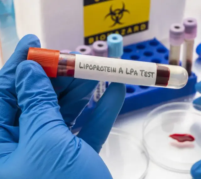 Badanie lipoproteiny A (LPA) to analiza krwi oceniająca ryzyko chorób serca.