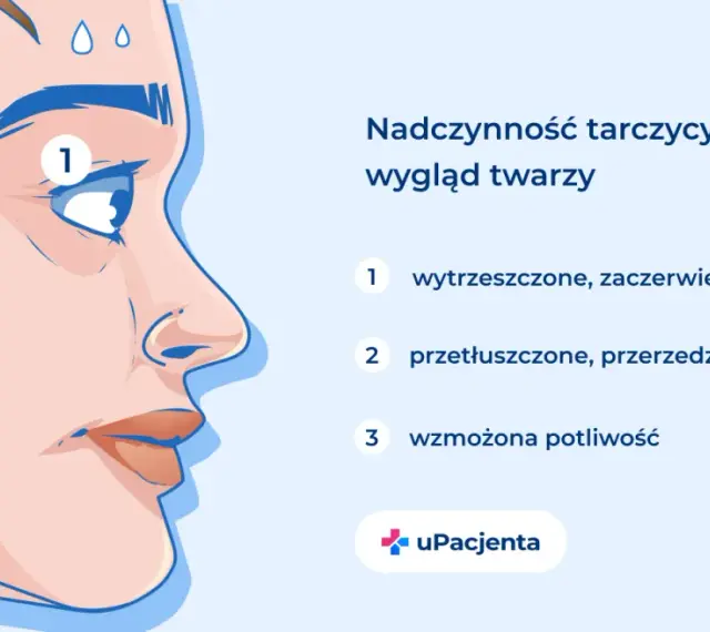 Nadczynność tarczycy objawy: wytrzeszczone oczy (1), przetłuszczone włosy (2) i wzmożona potliwość (3) na twarzy.