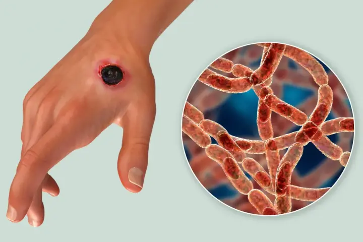 Dłoń z czarną martwiczą zmianą skórną, objawem wąglika. Obok powiększenie bakterii Bacillus anthracis.