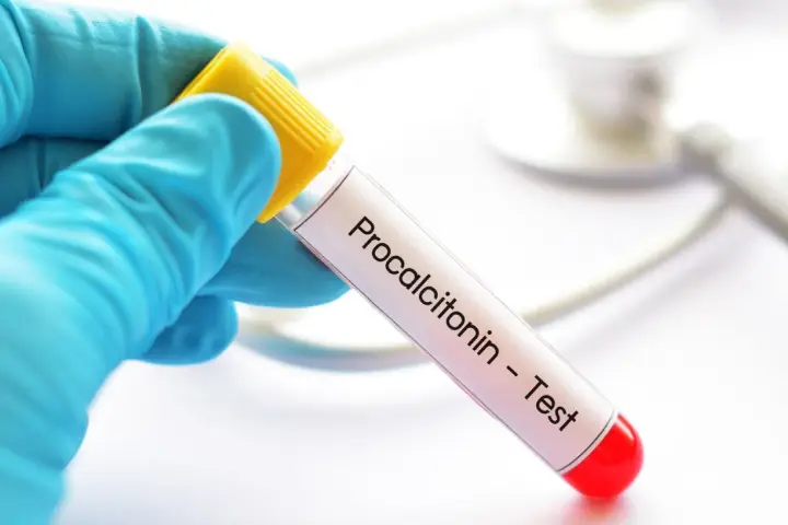 Ręka w niebieskiej rękawiczce trzyma probówkę z napisem "Procalcitonin - Test". To ważny pct.